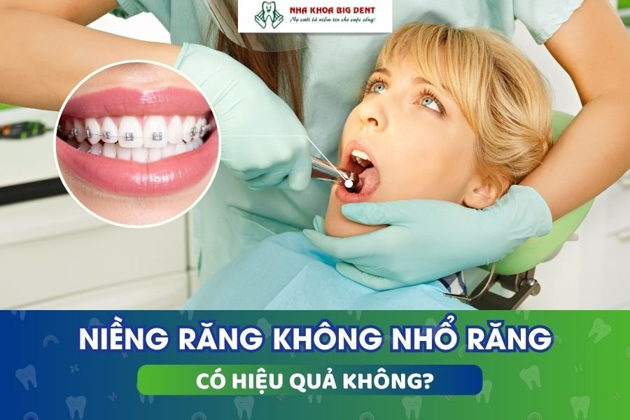 niềng răng không nhổ răng có hiệu quả không