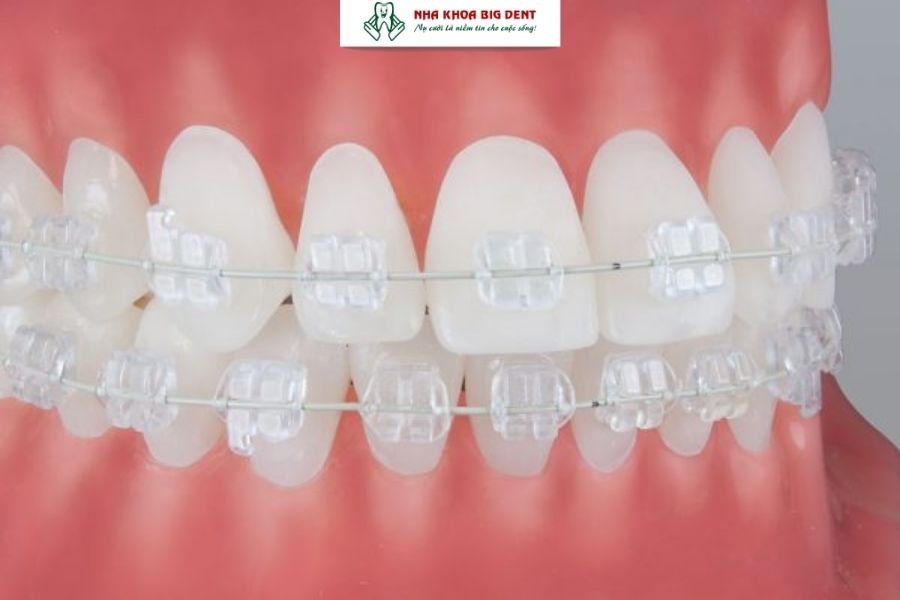 niềng răng mắc cài sapphire