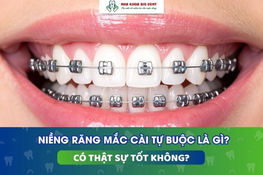 niềng răng mắc cài tự buộc