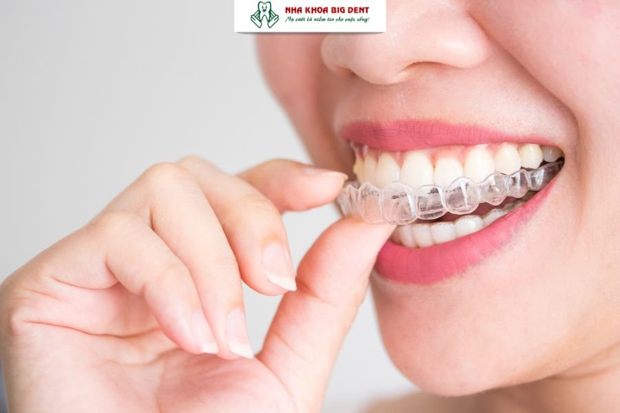 niềng răng trong suốt