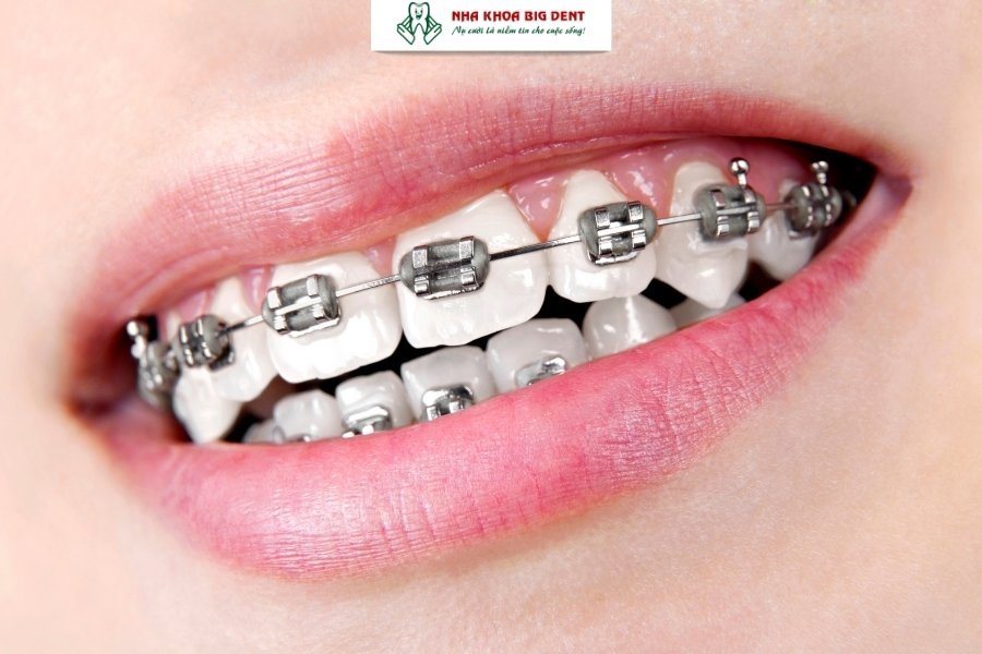 niềng răng mắc cài kim loại