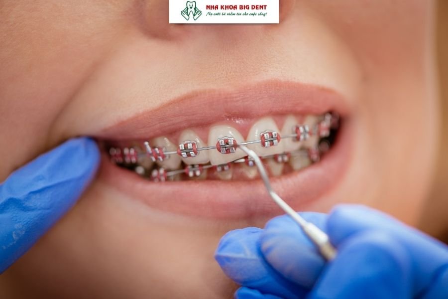 niềng răng mắc cài kim loại