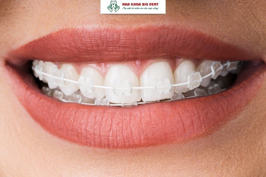 niềng răng mắc cài sứ