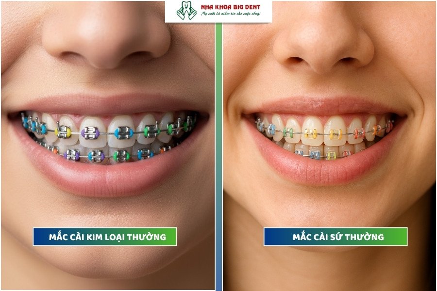 niềng răng mắc cài thường
