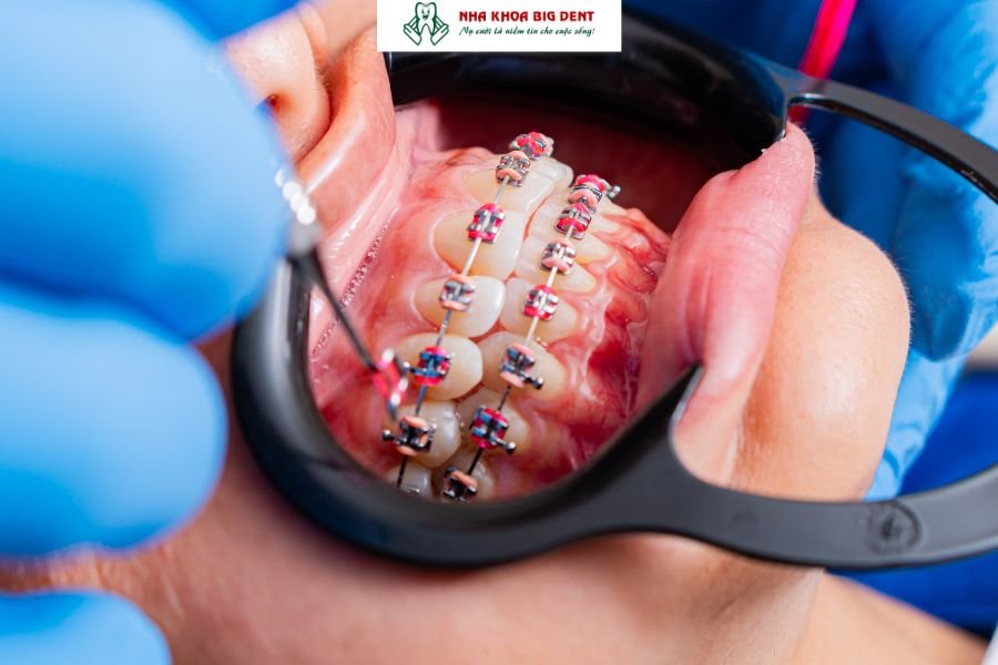 niềng răng mắc cài