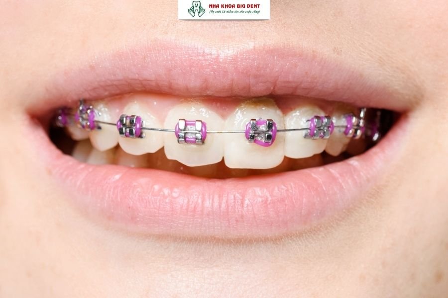 niềng răng mắc cài kim loại