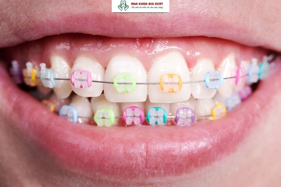 niềng răng mắc cài sứ