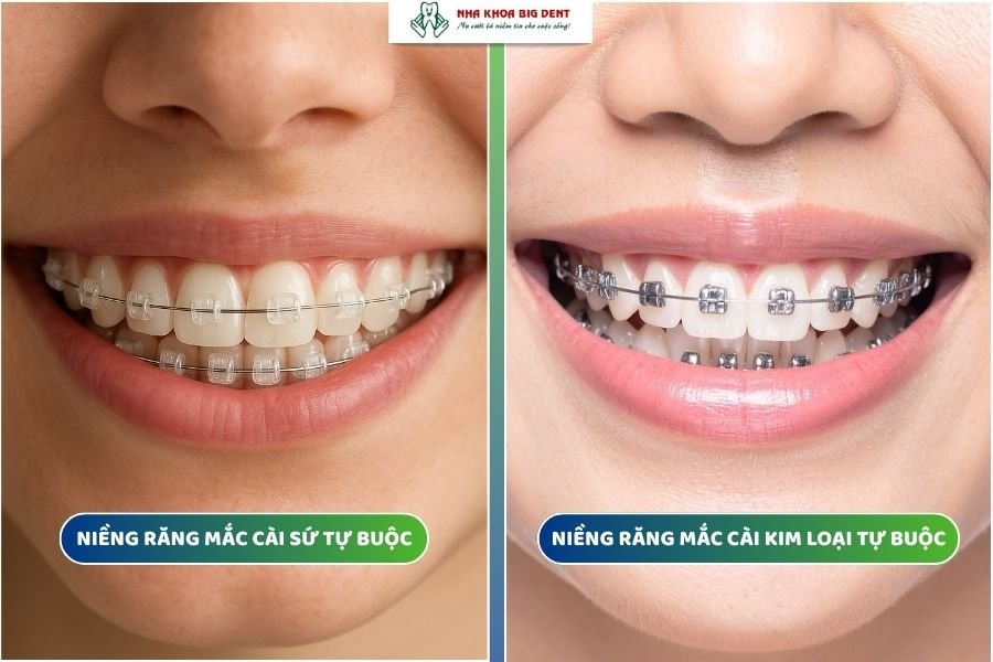 niềng răng mắc cài tự buộc