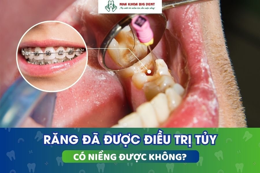 răng đã lấy tủy có niềng được không