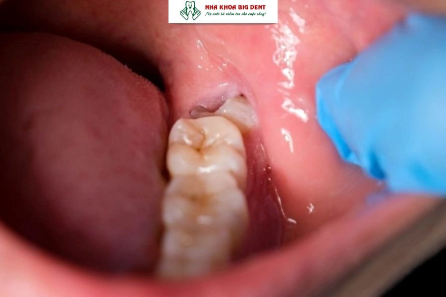 Răng khôn mọc lệch