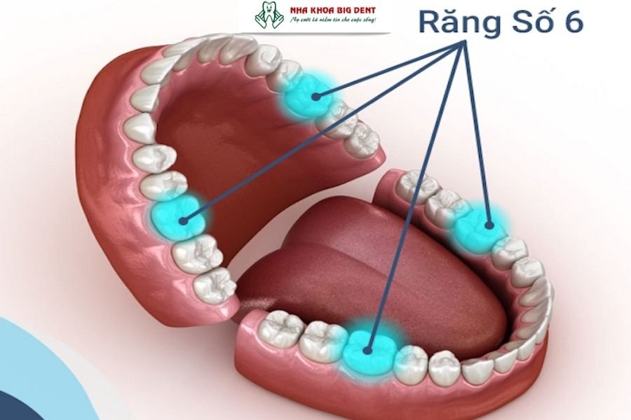 mất răng số 6 có niềng được không