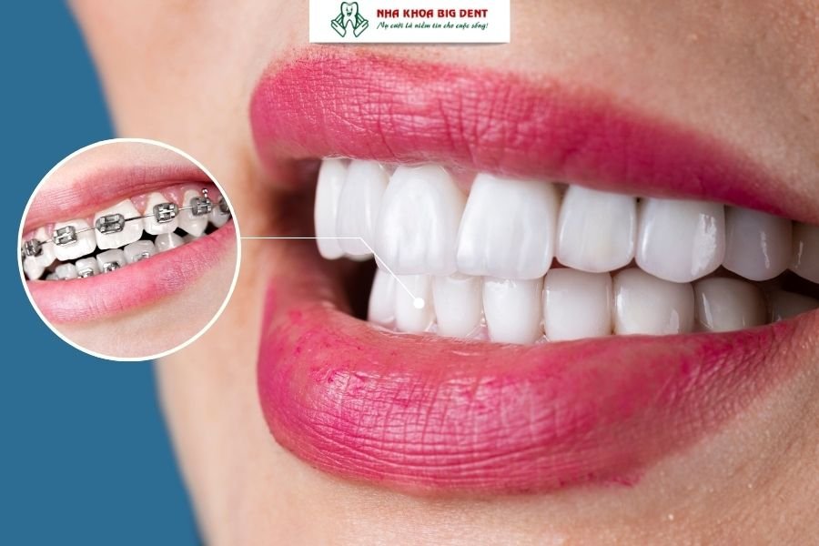 răng sứ có niềng được không