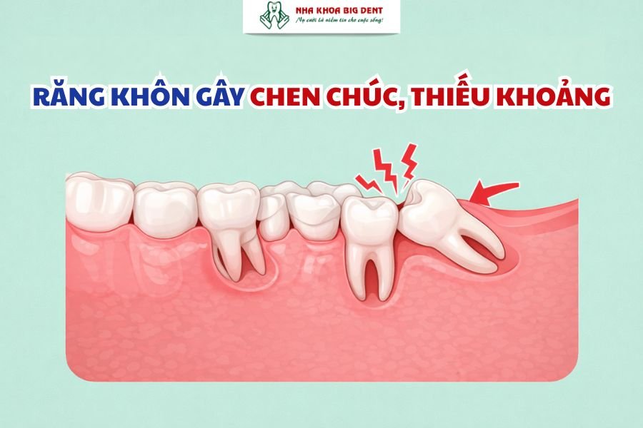 Răng khôn mọc gây chen chúc và thiếu khoảng