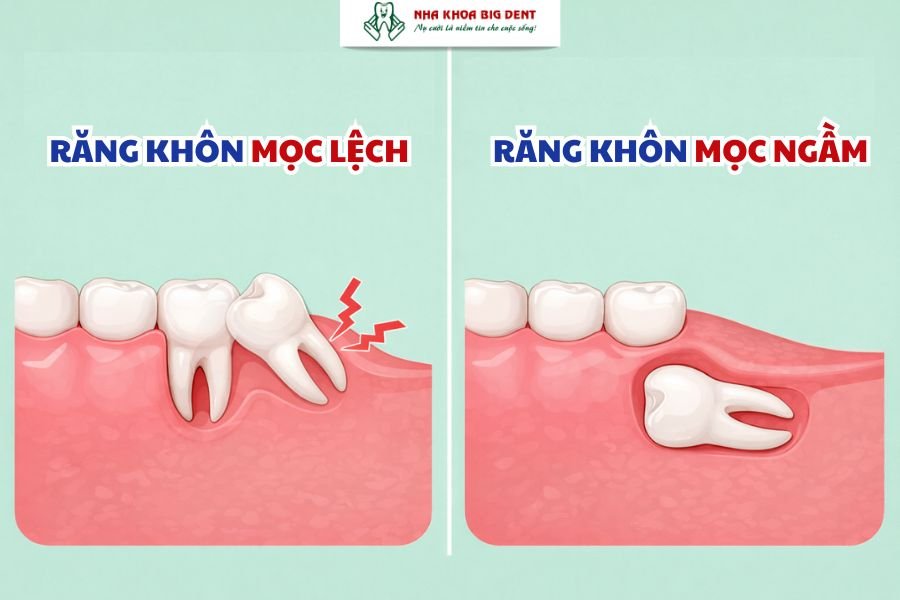 Tình trạng răng khôn mọc lệch hoặc mọc ngầm