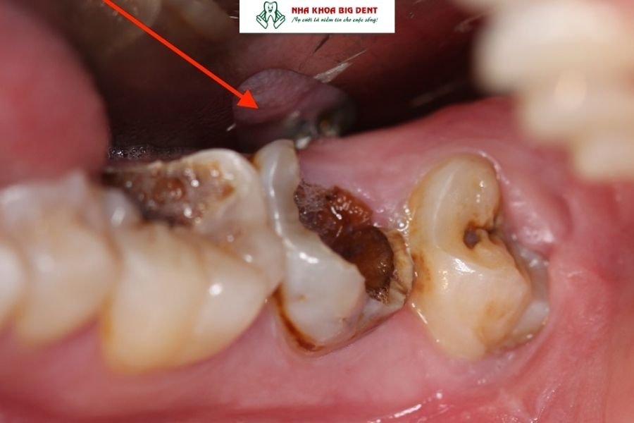 sâu răng gây viêm tủy