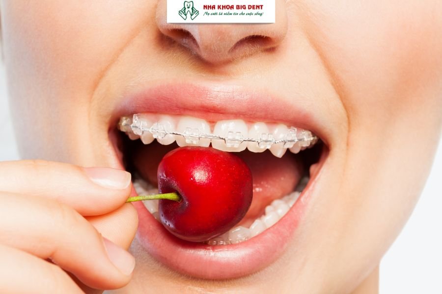 niềng răng mắc cài sapphire