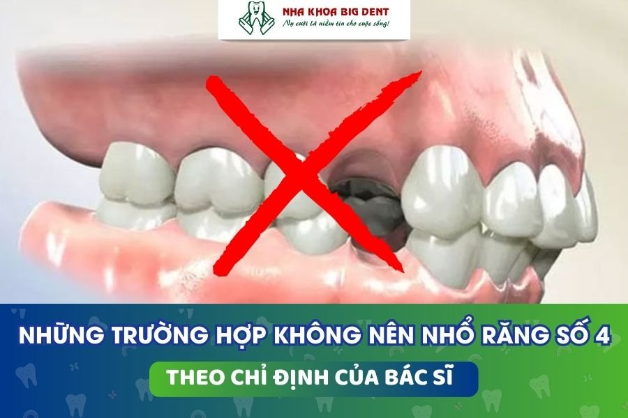 nhổ răng số 4 để niềng răng