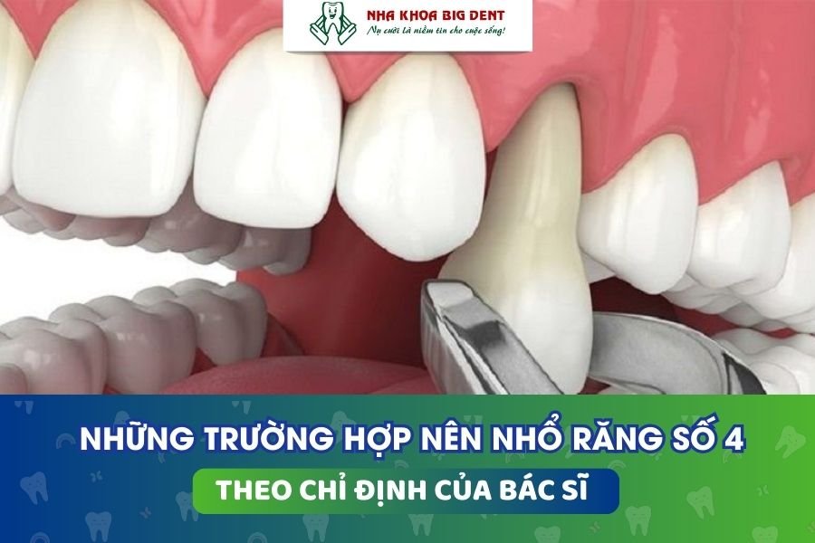 nhổ răng số 4 để niềng răng