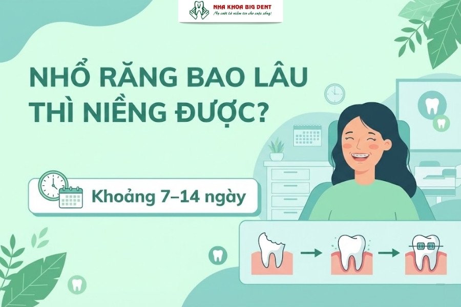 nhổ răng bao lâu thì niềng
