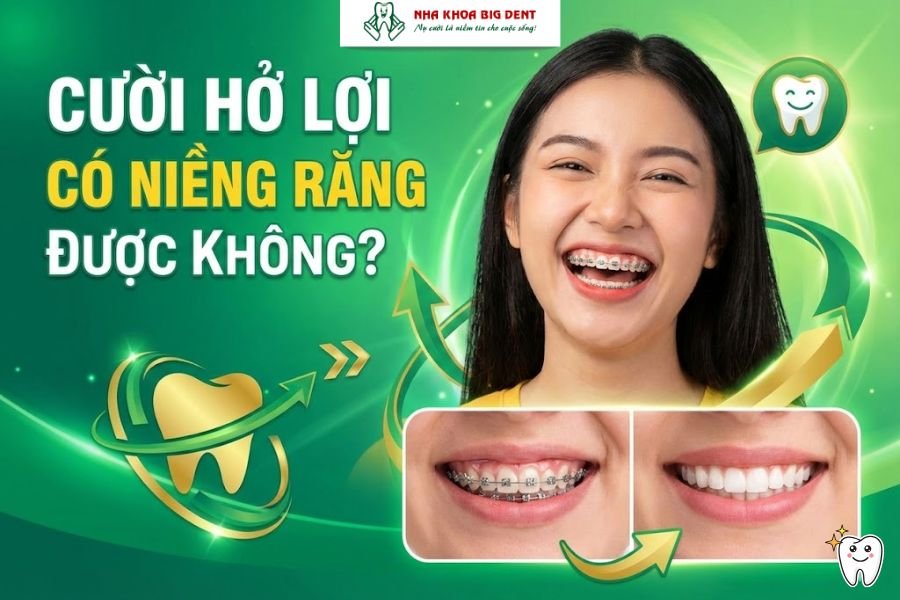 cười hở lợi có niềng răng được không