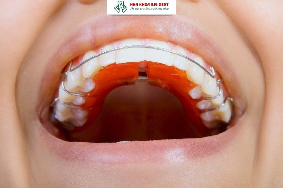 niềng răng đeo hàm duy trì bao lâu