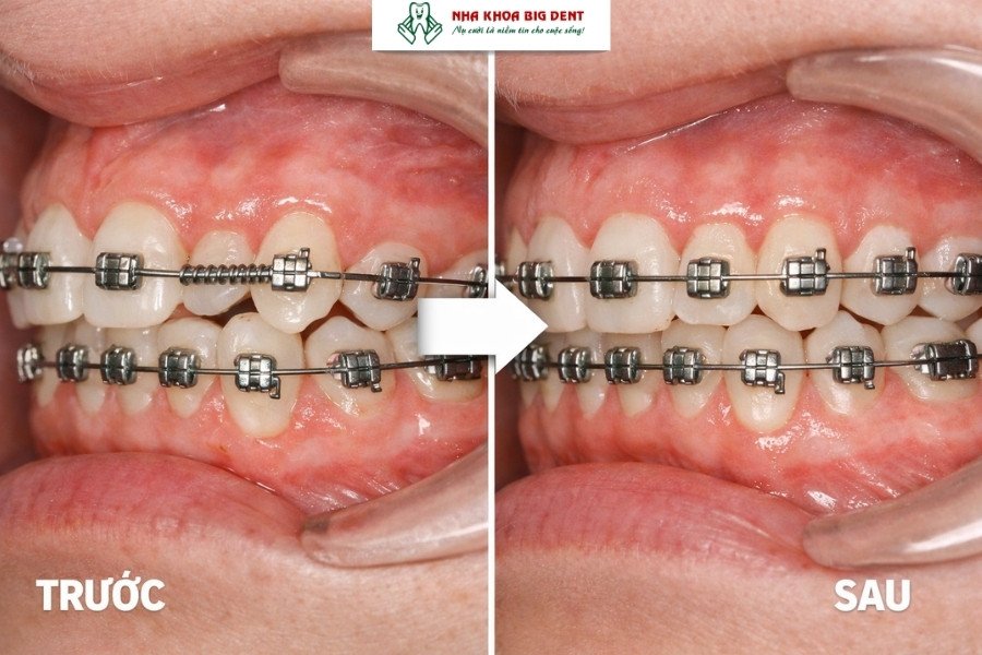 dịch chuyển răng