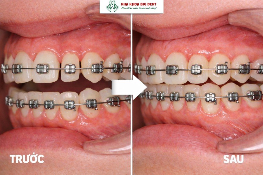 đóng khoảng răng