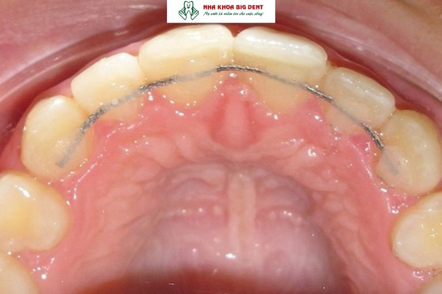 Hàm duy trì cố định.