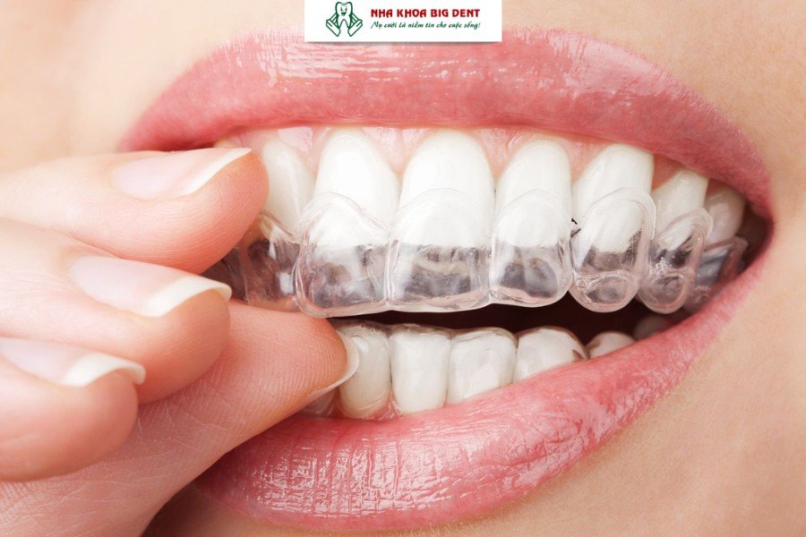 Hàm duy trì tháo lắp trong suốt.