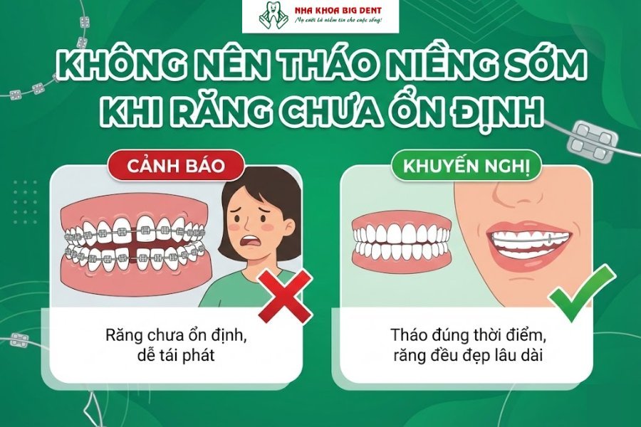 niềng răng bao lâu thì tháo