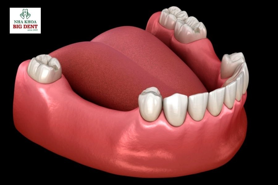 mất răng có niềng được không