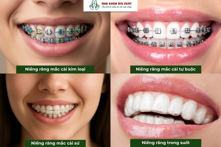 phương pháp niềng răng