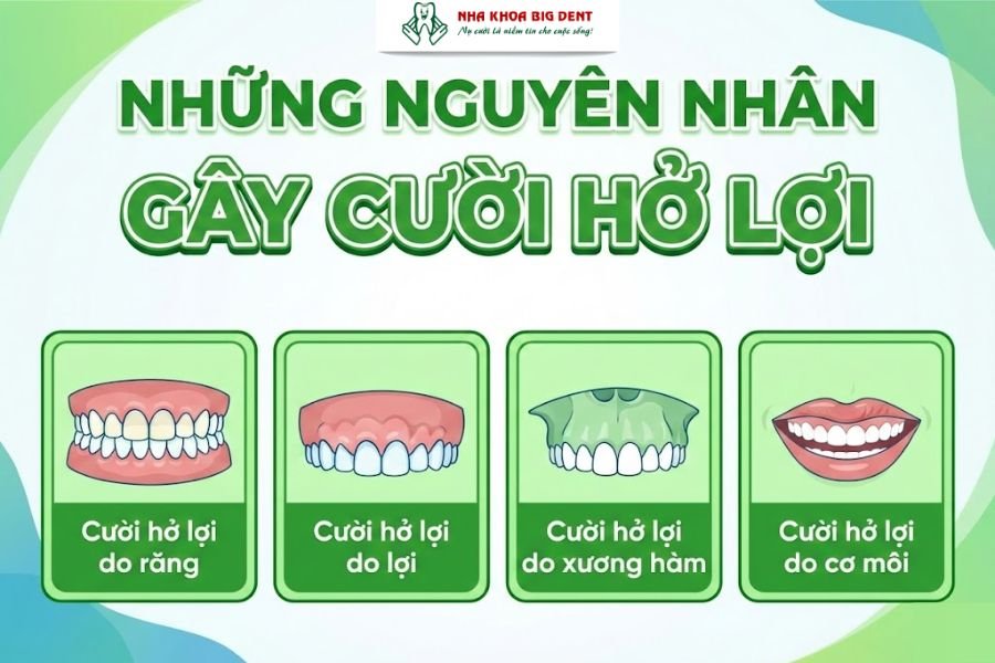 cười hở lợi có niềng răng được không