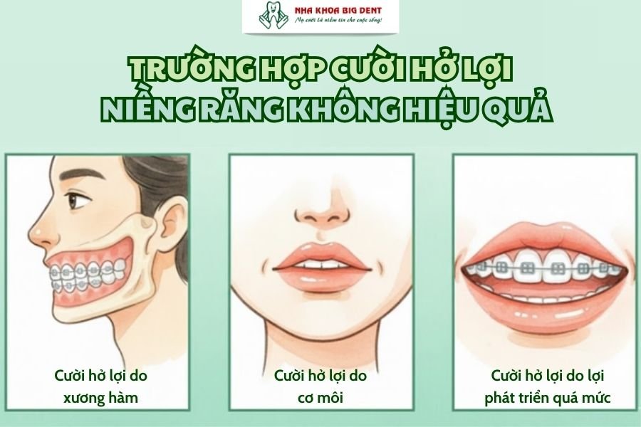 cười hở lợi có niềng răng được không