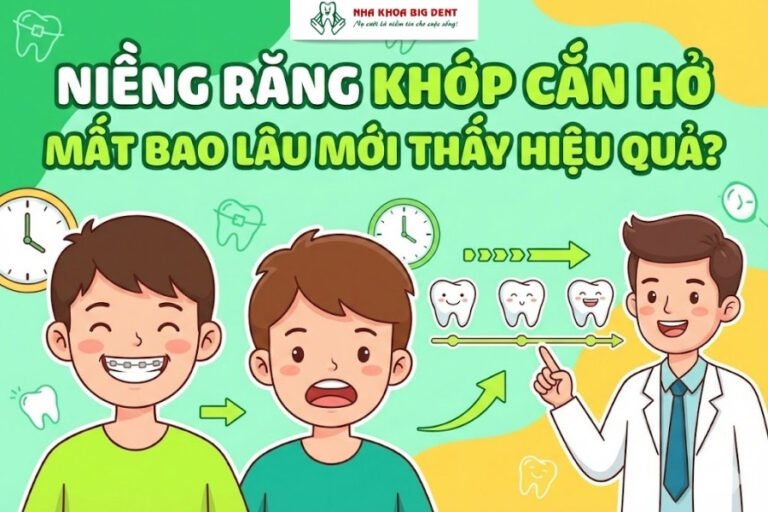 niềng răng khớp cắn hở mất bao lâu