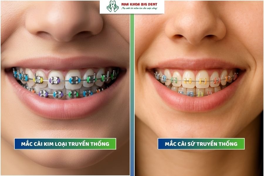 niềng răng mắc cài truyền thống