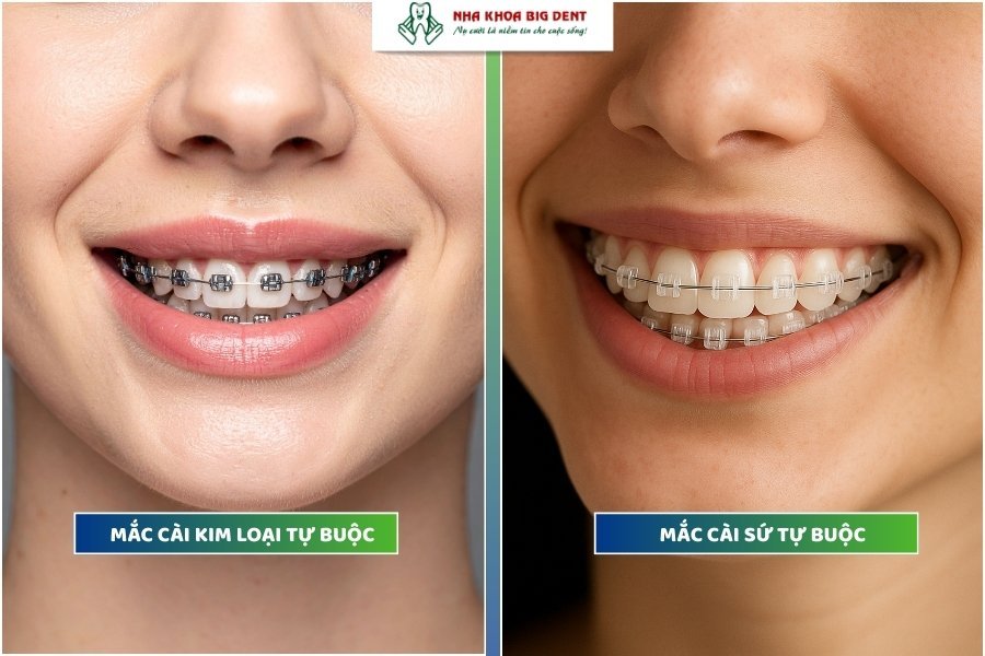 niềng răng mắc cài tự buộc