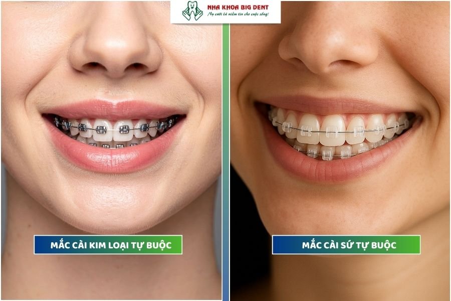 niềng răng mắc cài tự buộc