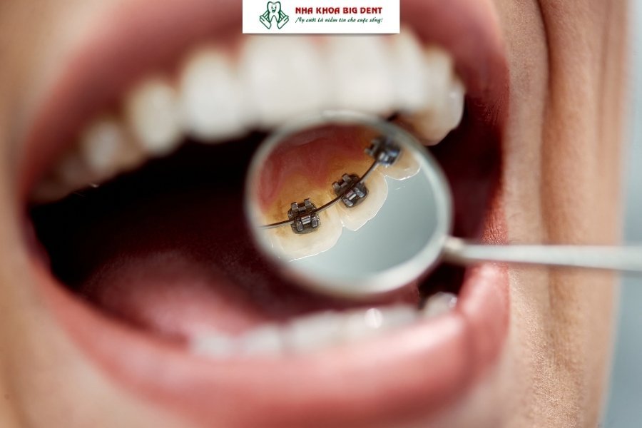 niềng răng mặt trong