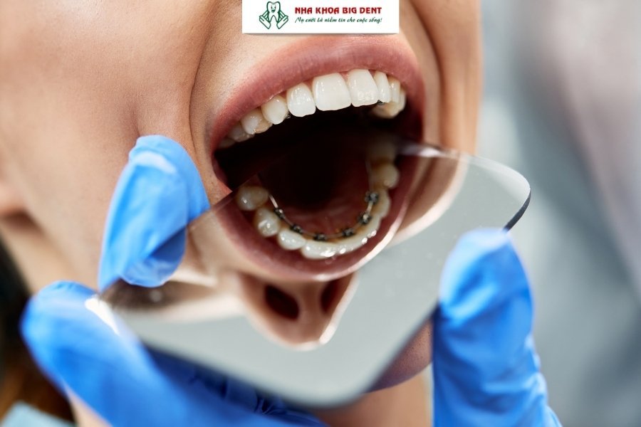 Niềng răng mắc cài mặt trong