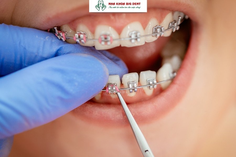 niềng răng mắc cài kim loại