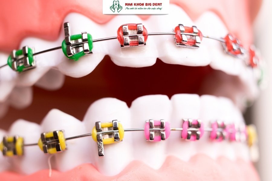 niềng răng mắc cài kim loại