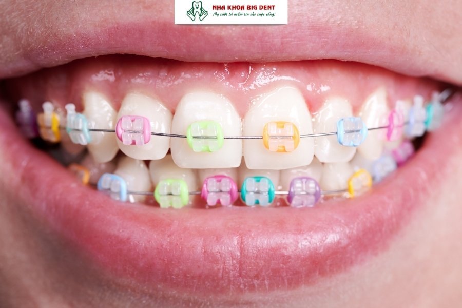 niềng răng mắc cài sứ