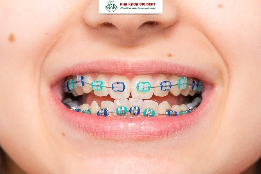 niềng răng mắc cài sứ