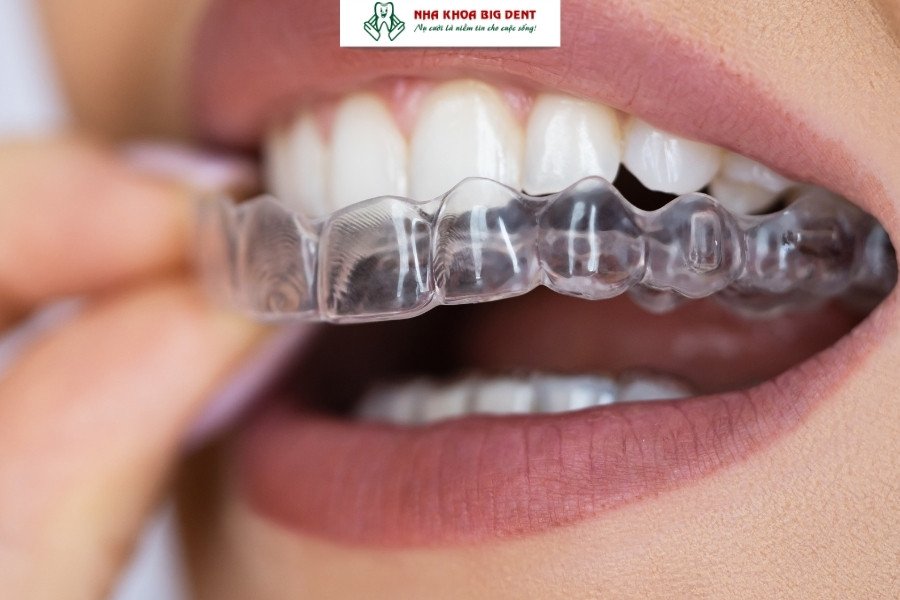 niềng răng trong suốt