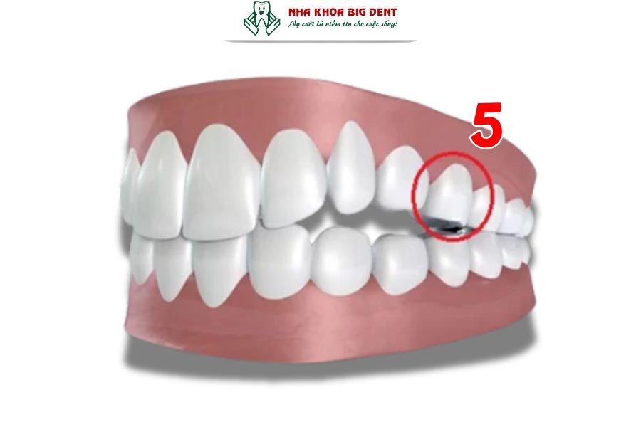 Răng số 5