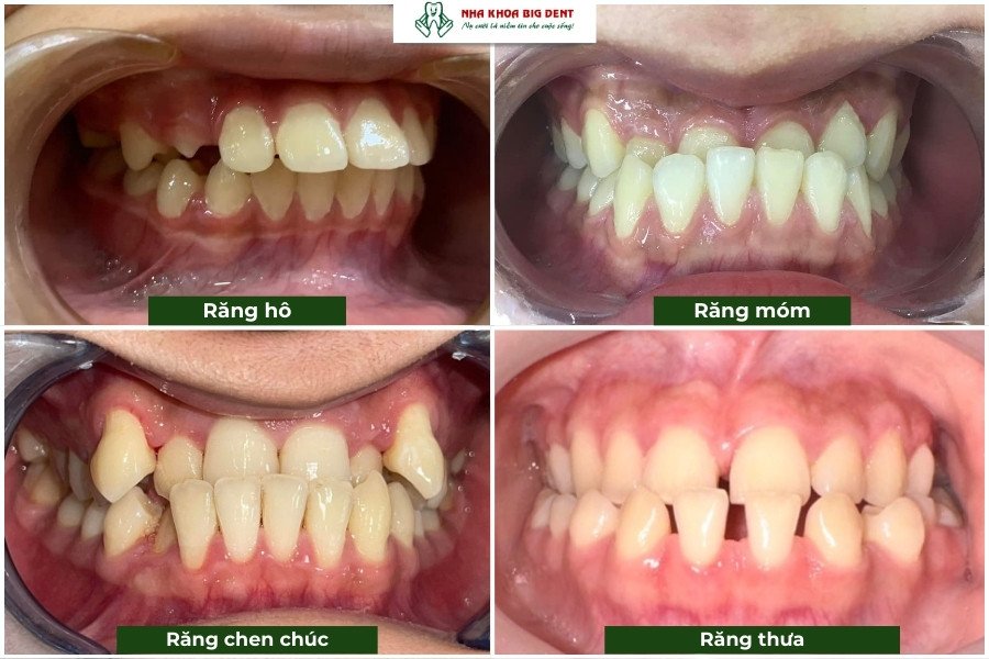 các tình trạng răng