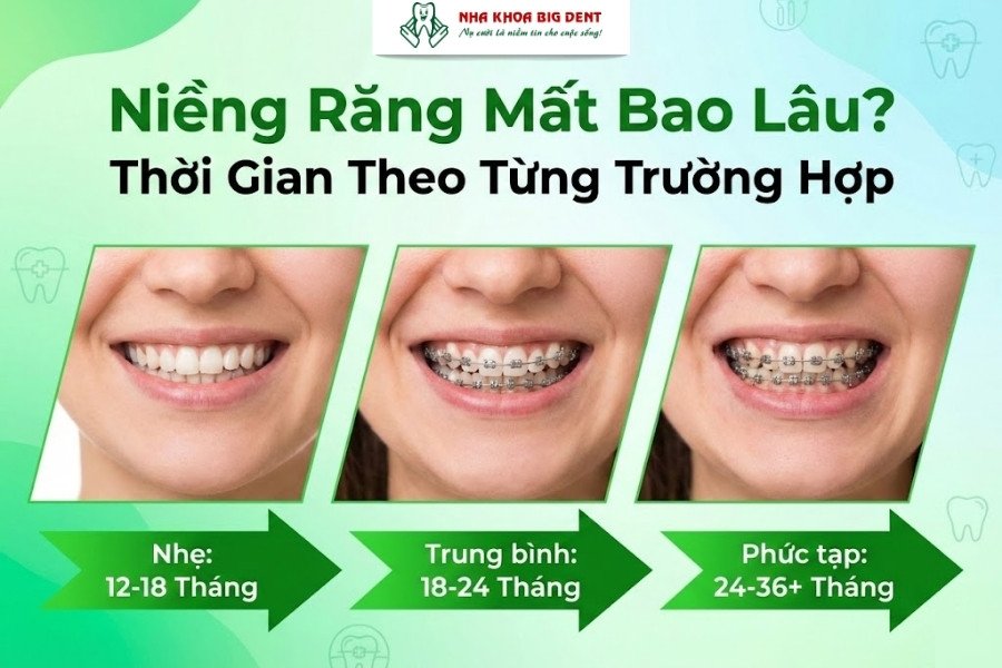 niềng răng mất bao lâu
