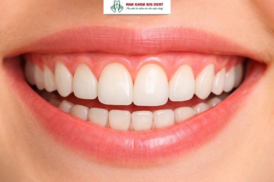 cười hở lợi có niềng răng được không