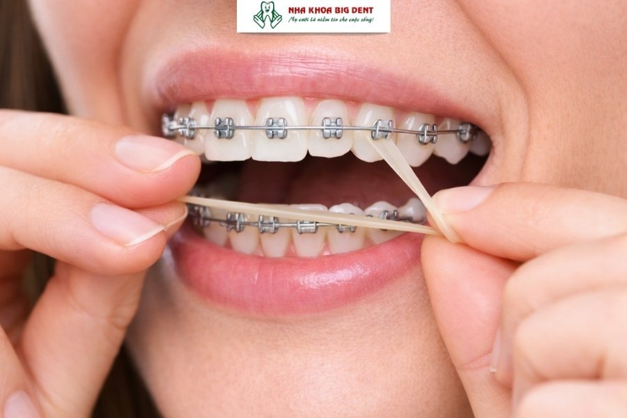 đeo thun liên hàm